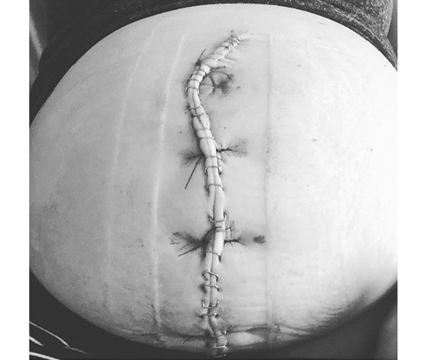 Paren de juzgar el parto ajeno: una madre muestra su enorme cicatriz de cesárea - 2