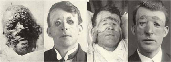 Veja como a Primeira Guerra deu início às cirurgias estéticas - 3